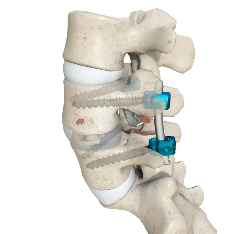 Kidney-Shaped Lumbar Interbody Fusion Cage