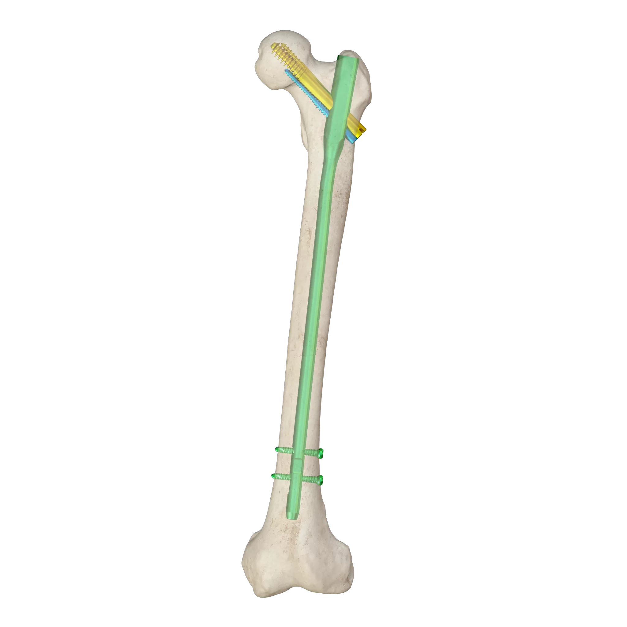 orthopedic implant, intramedllary nail, intramedllary nailing, im nail, im nailing, PFNA