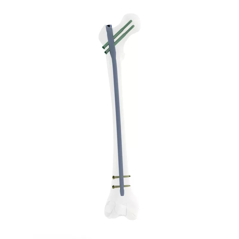 orthopedic implant, intramedllary nail, intramedllary nailing, im nail, im nailing, PFNA
