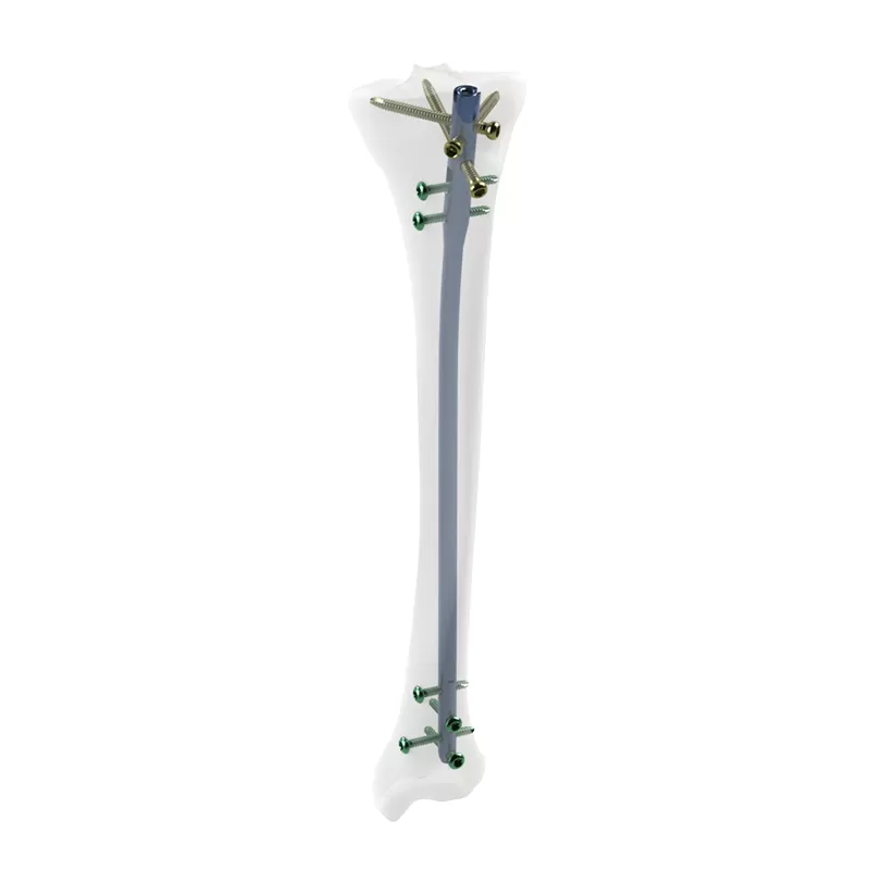 orthopedic implant, intramedllary nail, intramedllary nailing, im nail, im nailing, PFNA