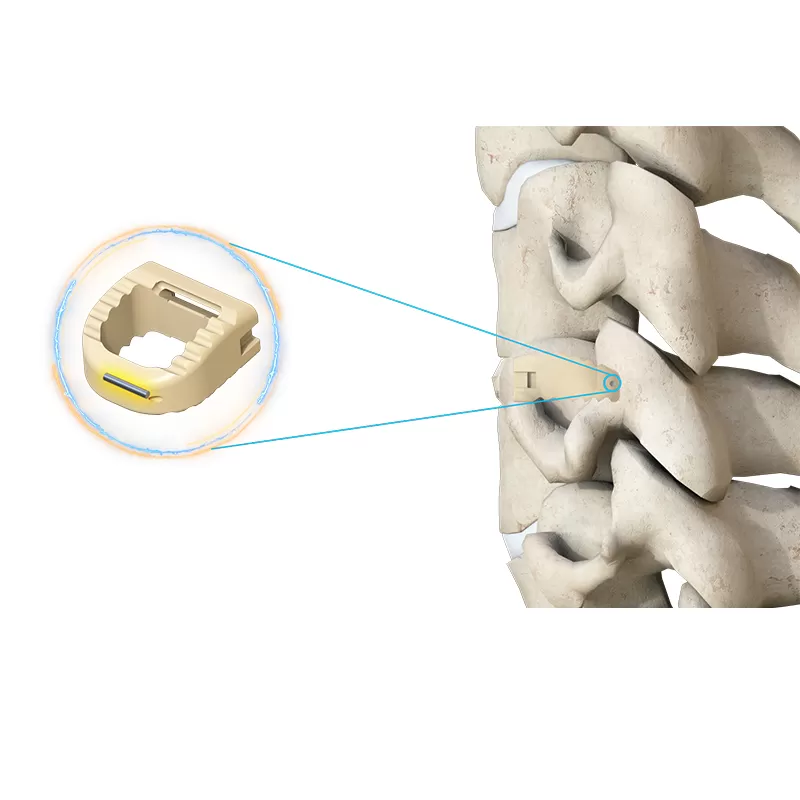 Uni-C Cervical Interbody Fusion Cage