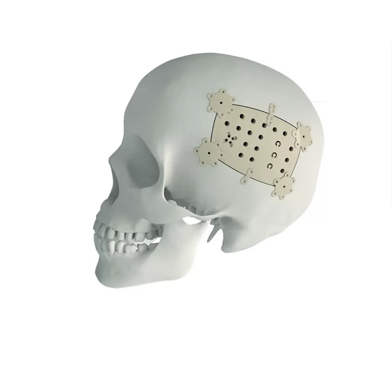 PEEK Cranial Repair System
