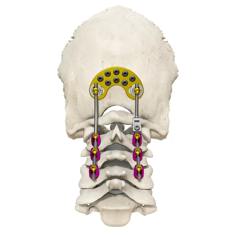 Occipital Plate - OCT System Components