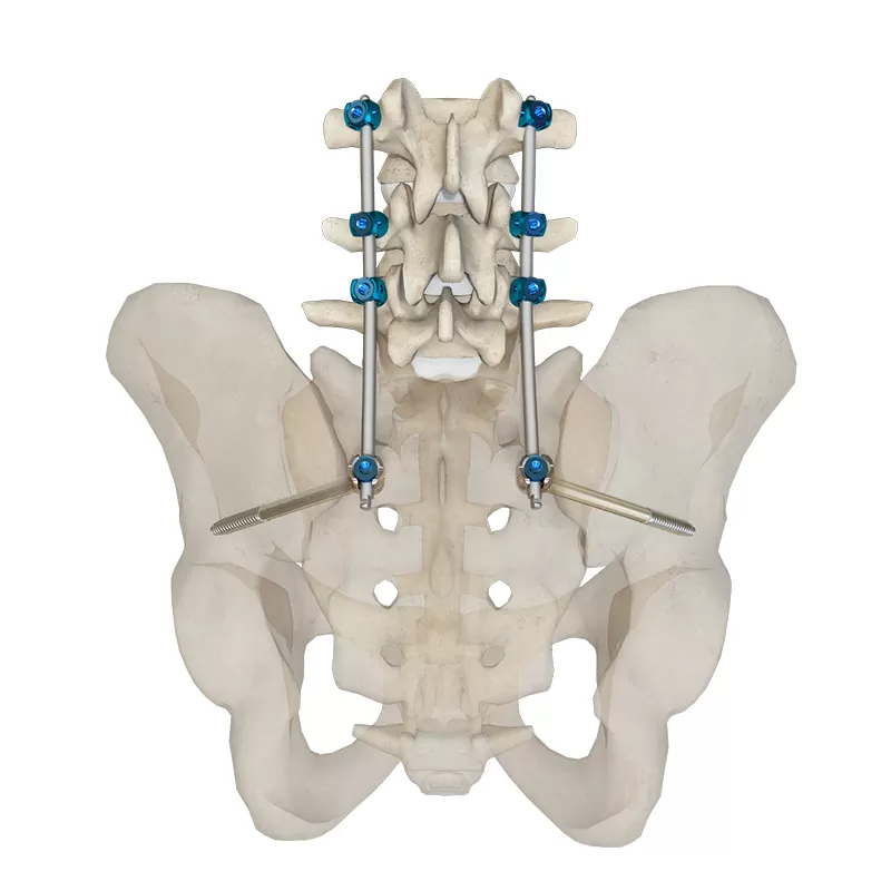 Iliac Screw for S2 Alar-Iliac Fixation Technique (5.5 system)