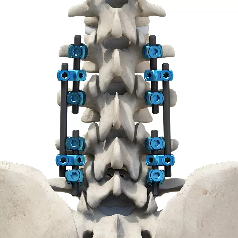 Adjacent Segment Disease Revision Surgery