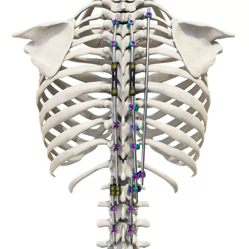 Reduction Polyaxial Screw (4.5 system)