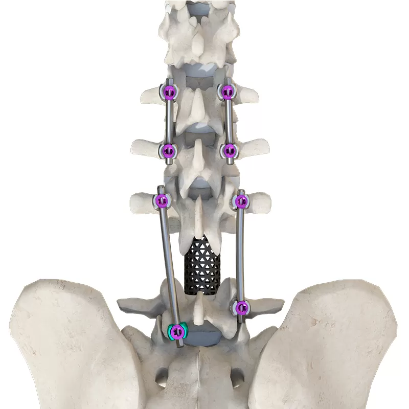 Reduction Polyaxial Screw (4.5 system)
