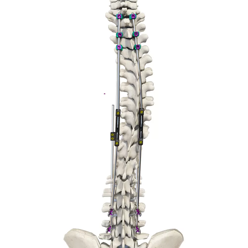CoCrMo Posterior Thoracolumbar Spinal System 4.5(for children)