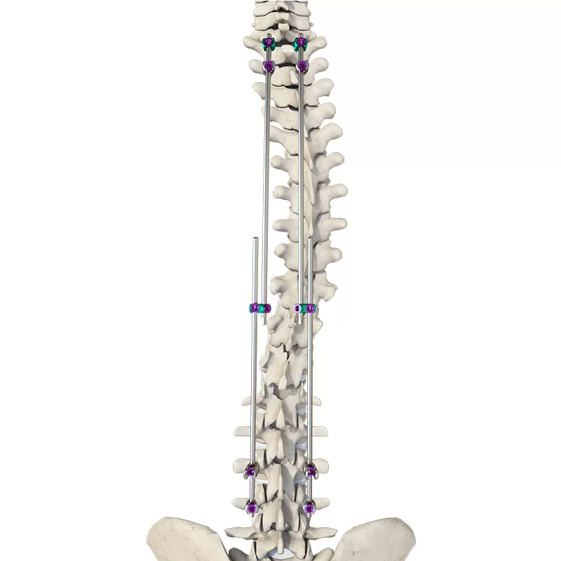 Reduction Polyaxial Screw (4.5 system)