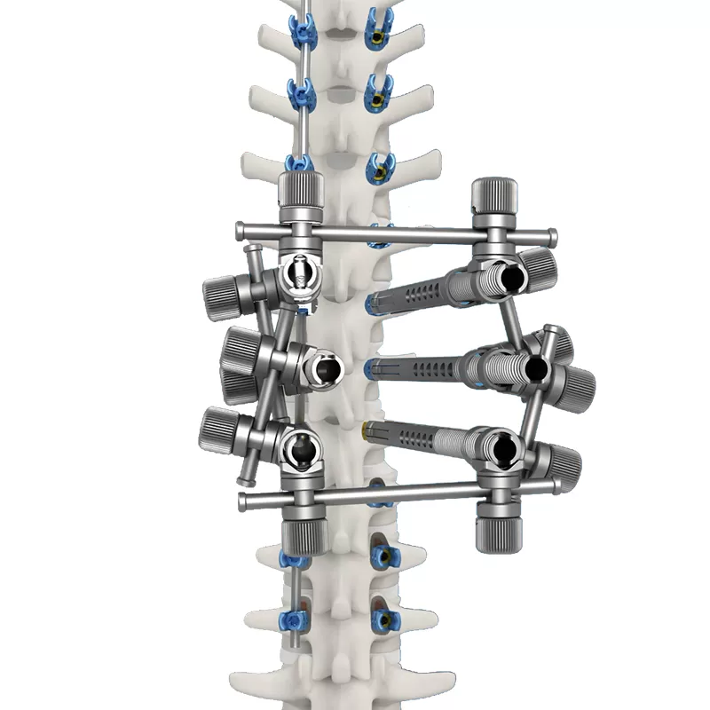 Ti Posterior Rod-Screw for Spinal Deformity (6.0 System)