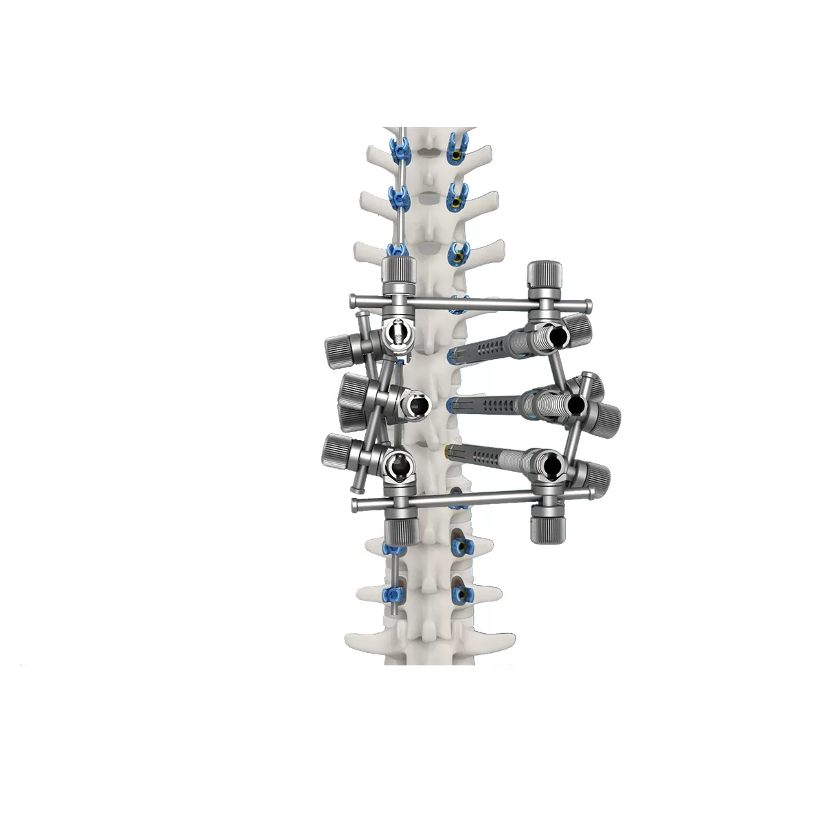 Spondylolisthesis Reduction Ball Nut
