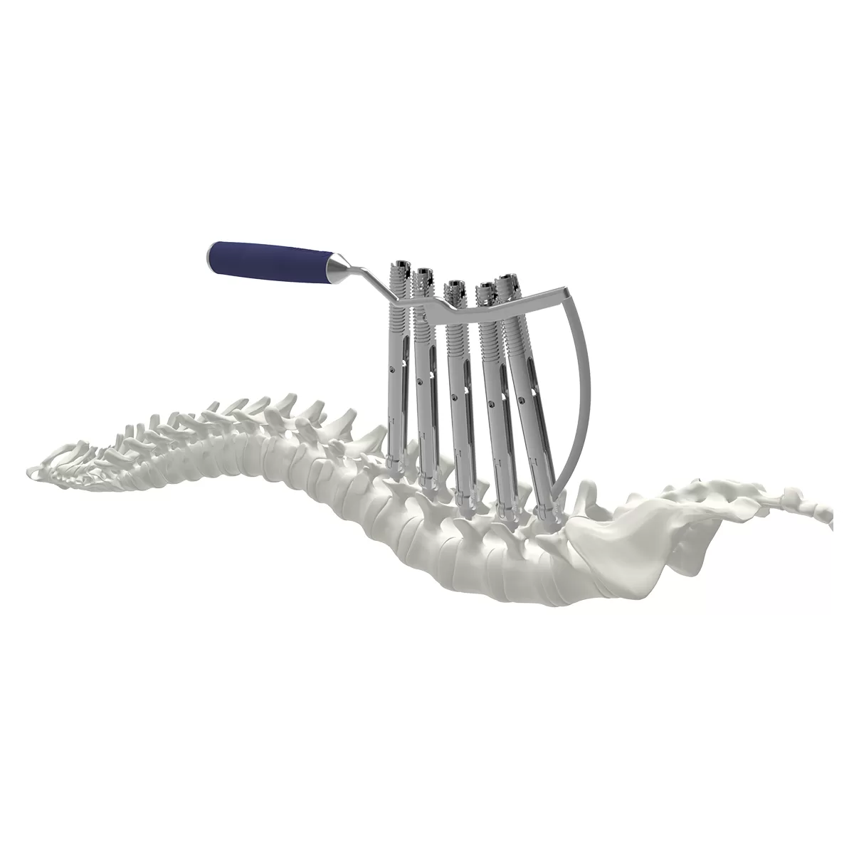 Ti MIS Percutaneous System 6.0
