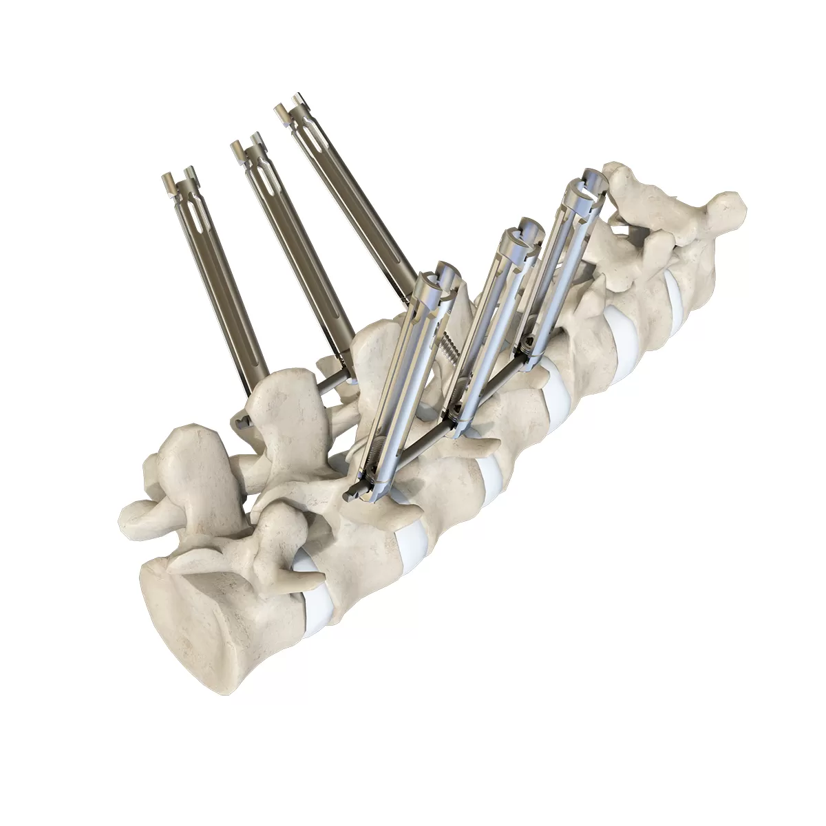 Ti MIS Extension Tab Percutaneous System 5.5