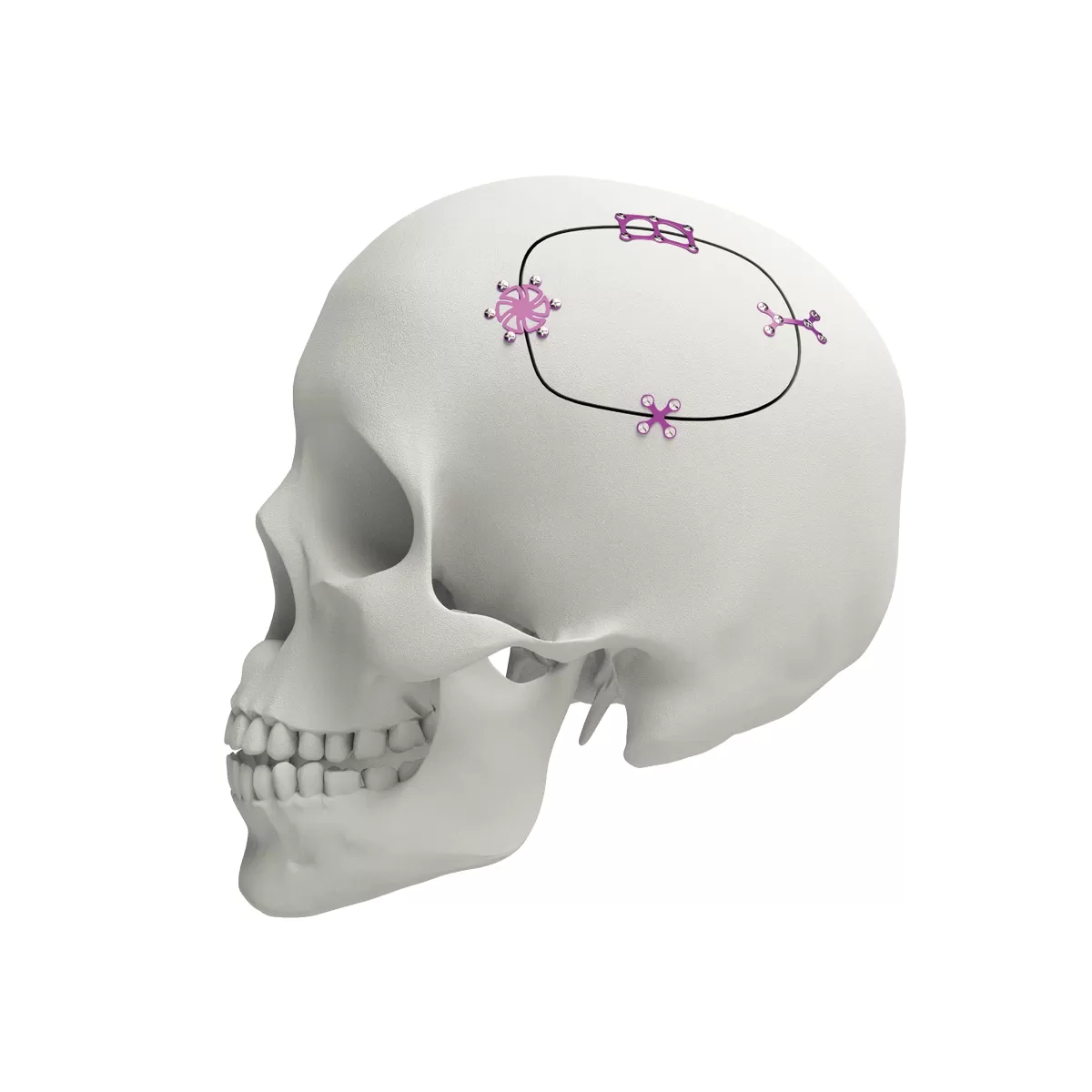 Burr Hole Cover, for shunt, 5 holes - Ultra Low Profile