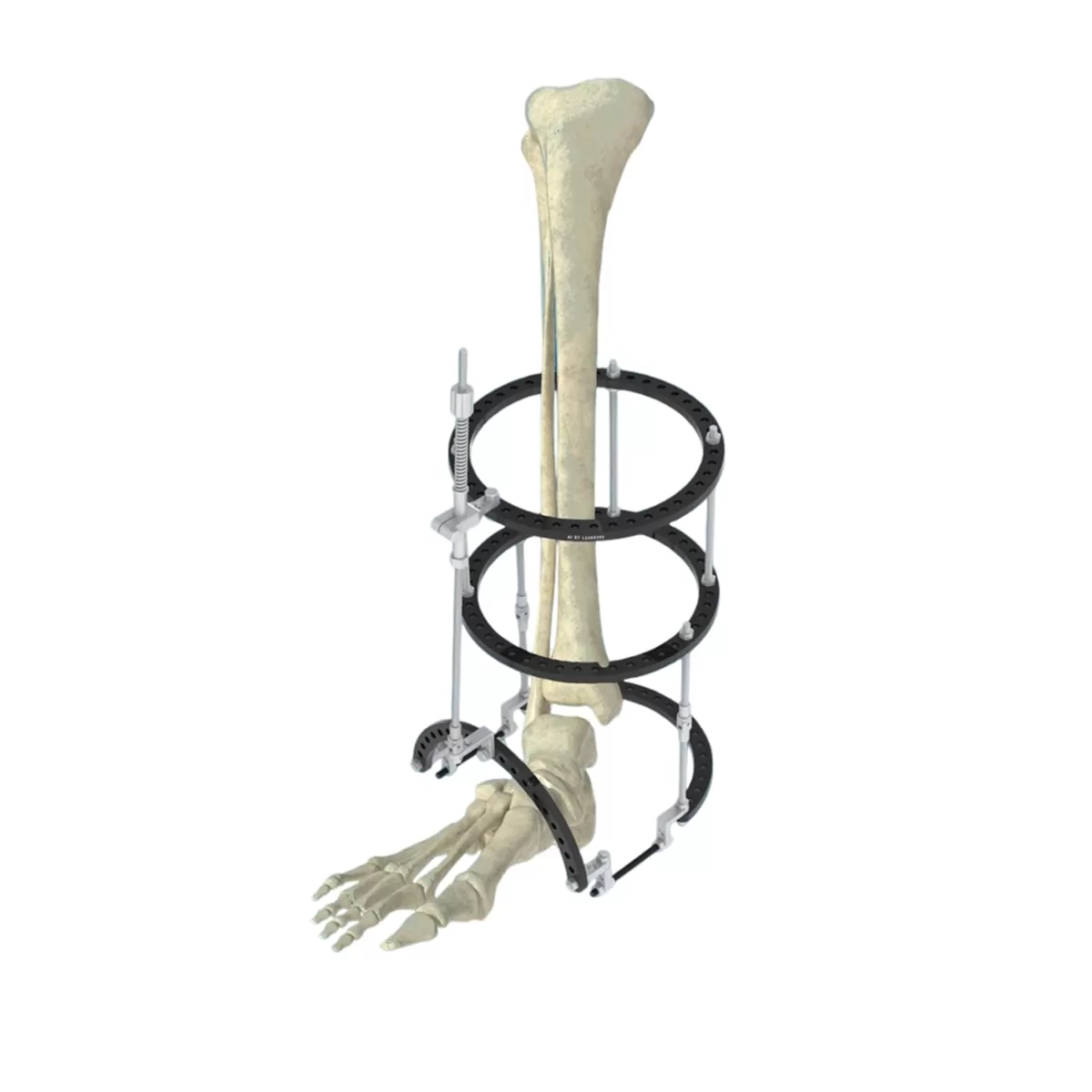 Ring-Type Multi-Function External Fixator