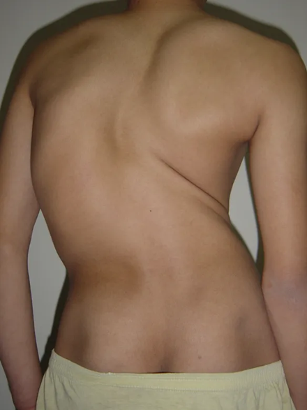 PUMC Classification and Solutions for Idiopathic Scoliosis