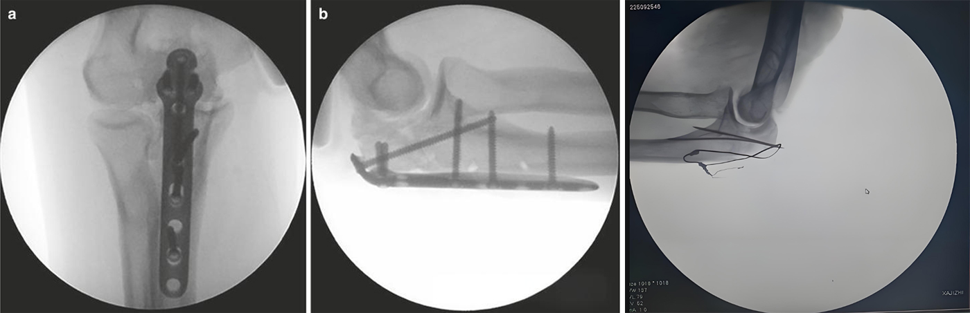 Internal Fixation Techniques for Olecranon Fractures of the Ulna Internal Fixation Techniques for Olecranon Fractures of the Ulna