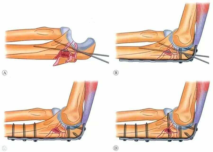 Internal Fixation Techniques for Olecranon Fractures of the Ulna Internal Fixation Techniques for Olecranon Fractures of the Ulna