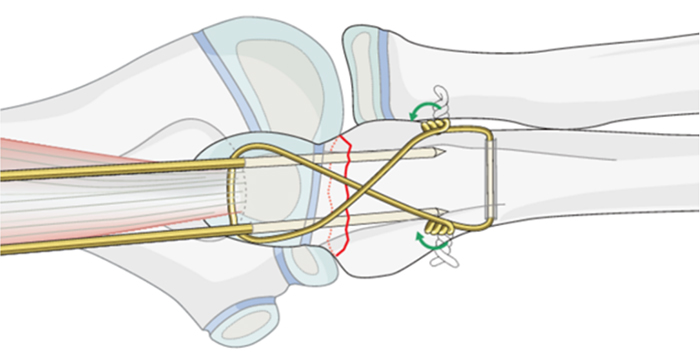 Internal Fixation Techniques for Olecranon Fractures of the Ulna Internal Fixation Techniques for Olecranon Fractures of the Ulna