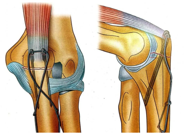 Internal Fixation Techniques for Olecranon Fractures of the Ulna Internal Fixation Techniques for Olecranon Fractures of the Ulna