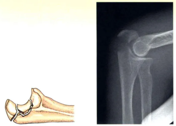 Internal Fixation Techniques for Olecranon Fractures of the Ulna Internal Fixation Techniques for Olecranon Fractures of the Ulna