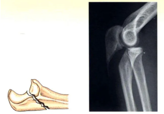 Internal Fixation Techniques for Olecranon Fractures of the Ulna Internal Fixation Techniques for Olecranon Fractures of the Ulna