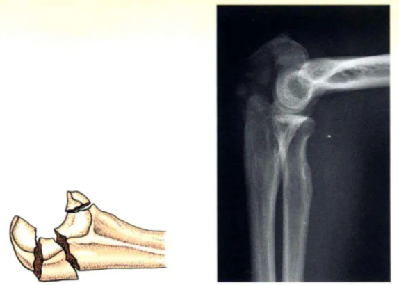 Internal Fixation Techniques for Olecranon Fractures of the Ulna Internal Fixation Techniques for Olecranon Fractures of the Ulna