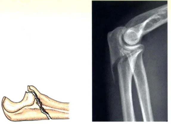 Internal Fixation Techniques for Olecranon Fractures of the Ulna Internal Fixation Techniques for Olecranon Fractures of the Ulna