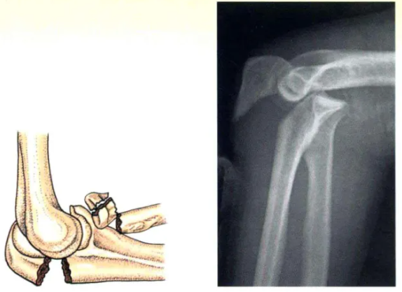 Internal Fixation Techniques for Olecranon Fractures of the Ulna Internal Fixation Techniques for Olecranon Fractures of the Ulna
