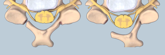 Lamina Fixation System