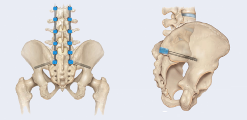 Thoracolumbar Percutaneous Screw & Rod System - Sacroiliac Thoracolumbar Percutaneous Screw & Rod System - Sacroiliac