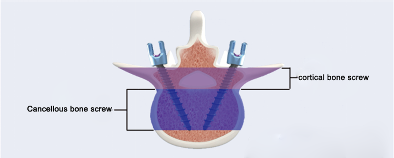 Decompression Fusion System Decompression Fusion System
