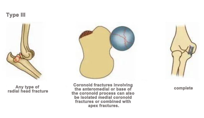 anteromedial coronoid fracture, consistent with the anteromedial facet fracture anteromedial coronoid fracture, consistent with the anteromedial facet fracture