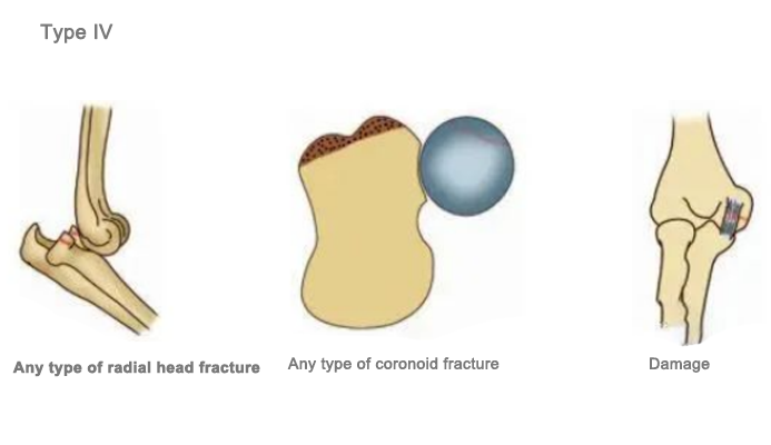 radial head fracture, coronoid fracture radial head fracture, coronoid fracture