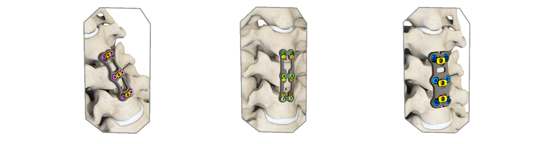  ACDF plates